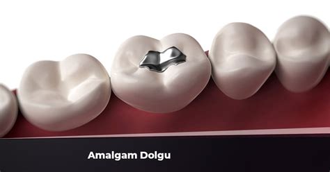 Amalgam Dolgu