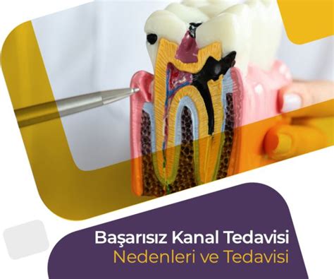 Başarısız Kanal Tedavisi Belirtileri Nelerdir?