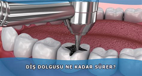 Diş dolgusu ne kadar sürer?