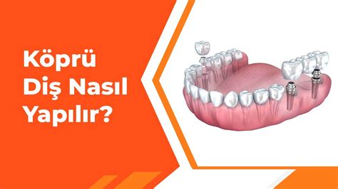 Hatalı Köprü Tedavisi Nasıl Anlaşılır? Belirtiler ve Çözümler