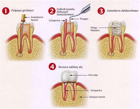 Kanal Tedavisi Aşamaları
