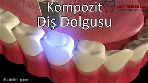 Kompozit Diş Dolgusu: Avantajlar ve Dezavantajlar