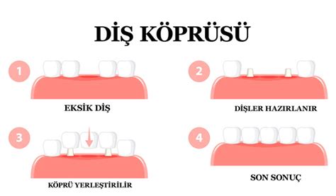 Köprü Tedavisi Adımları