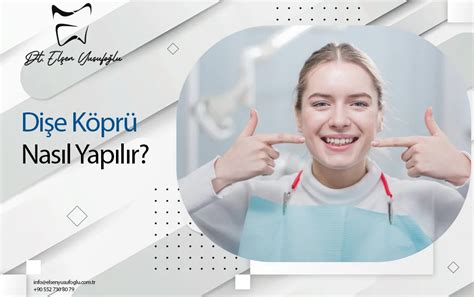 Köprü Tedavisi: Sıkça Sorulan Sorular ve Uzman Cevapları