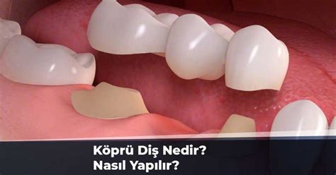 Köprü Tedavisinin Dayanıklılığı Nasıl Sağlanır?