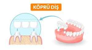 Köprü Tedavisinin Fonksiyonel Faydaları