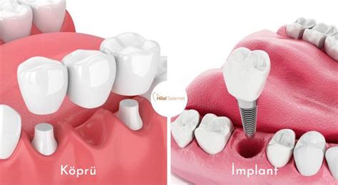 Köprü ve implant seçenekleri