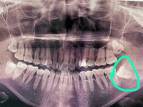 Kron Tedavisi Sonrası İyileşme Süreci: Ne Beklemelisiniz?