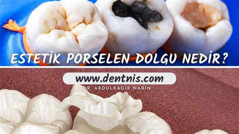 Porselen Dolgu Nedir?