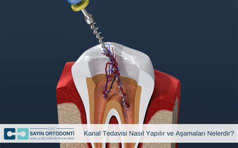 Diş Çürüklerinden Kanal Tedavisine: İşlemin Aşamaları ve Süreçleri