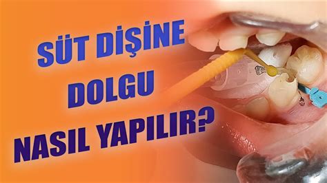 Diş Dolgusu Yerine Kullanılabilecek Nadir Malzemeler