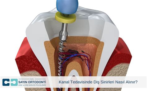 Endodontist mi, Diş Hekimi mi? Kanal Tedavisinde Doğru Uzman Seçimi