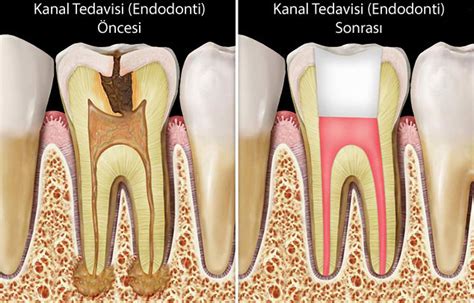 diş kanal tedavisi süresi