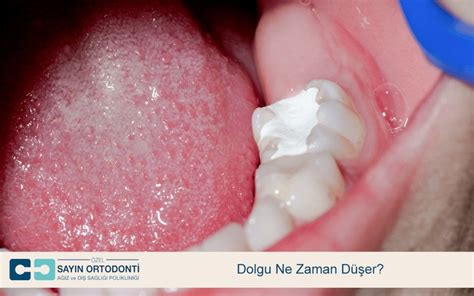 diş dolgusu düşerse yapılması gerekenler