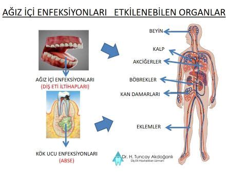 kanal tedavisi sonrası zonklama