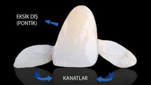 köprü tedavisinin estetik ve fonksiyonel faydaları