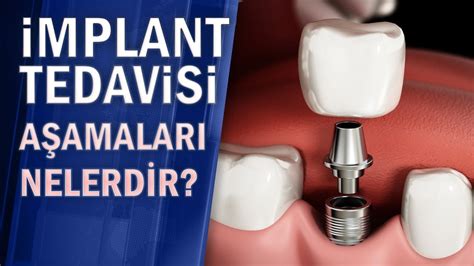 köprü tedavisi sıkça sorulan sorular